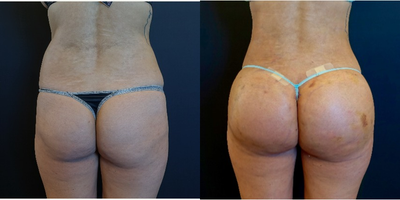 25-34 year old woman treated with Butt Implants - The patient had 548cc silicone butt implants and 350cc of fat transfer per side.  She also underwent liposculpting of the waist.  The pictures show her at one week post-op from her butt augmentation.  The combination of fat transfer, liposculpting and butt implants transforms her from square to hourglass figure!