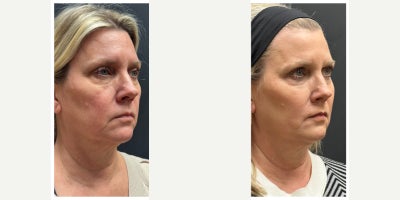 55-64 year old woman treated with Dermal Fillers, Chin Filler - Full facial balancing. 4 syringes in the patients cheeks, chin, jawline, marionette lines, pre-jowl area.