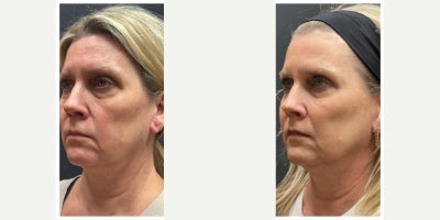55-64 year old woman treated with Dermal Fillers, Chin Filler - Full facial balancing. 4 syringes in the patients cheeks, chin, jawline, marionette lines, pre-jowl area.