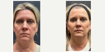 55-64 year old woman treated with Dermal Fillers, Chin Filler - Full facial balancing. 4 syringes in the patients cheeks, chin, jawline, marionette lines, pre-jowl area.