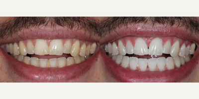 25-34 year old man treated with Zoom Whitening - Zoom! In-Office Whitening was all this patient needed to get a bright, white smile! The procedure takes about 3 hours but results are immediate.