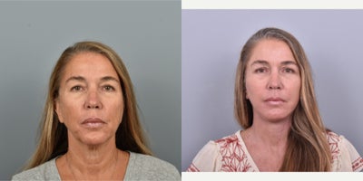 55-64 year old woman treated with Facial Fat Transfer, Eyelid Surgery, Facelift, Neck Lift, Fractional Laser - This patient received an upper blepharoplasty. She also received fractional CO2 laser to her face, neck and chest.