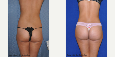 Butt Augmentation - Butt Augmentation