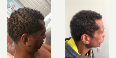 45-54 year old man treated with ALMI - ALMI for hair loss using stem cells and PRP