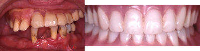 Dental Implants - 
	Pt with poor teeth which were non restorable had all teeth removed, bone smoothing, bone grafting and 4 dental implants placed in upper jaw and 4 implants placed on the lower jaw. Resored teeth with attachments to implants, overdentures
