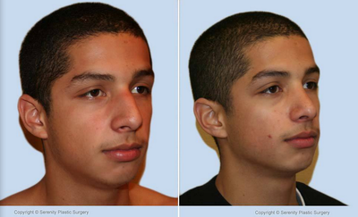 Rhinoplasty - Rhinoplasty