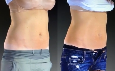 UltraShape - New York's Alizadeh Cosmoplastic Surgery team uses the entirely nonsurgical treatment to reduce bulges for a slimmer look. Contact us to discover how each session is customized to the patient. Link in bio.