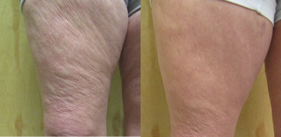 Woman treated with BodyFX - Woman treated with BodyFX to treat cellulite on upper thigh area.