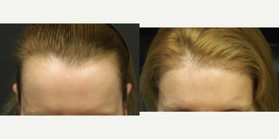 45-54 year old woman treated with Forehead Reduction  with Hair Transplant - Forehead Reduction with Hair Transplant 
Forehead Reduction cannot round out the front corners