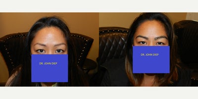 25-34 year old woman treated with Eyebrow Transplant - Eyebrow Transplant done by Dr. Diep!