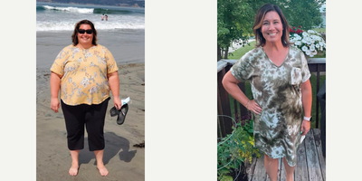 Woman treated with Gastric Bypass - Woman treated withGastric Bypass 