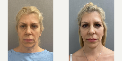 55 year old woman treated with NaturalLift - 55 year old woman treated with NaturalLift