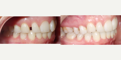 25-34 year old woman progress in Lingual Braces - 8 month smile progress in lingual, incognito braces that straighten from behind your teeth