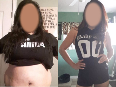 25-34 year old woman treated with Sleeve Gastrectomy - Over 100 lbs down since surgery