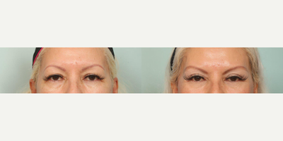 55-64 year old woman treated with Eyelid Surgery - Performed by Dr.Sozer