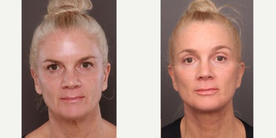 55-64 year old woman treated with Halo Laser, Sculptra, Botox, Dermal Fillers, Facelift, Brow Lift - See this patient's journey over the course of 2.5 years. Age 57. She had a Brow lift & Facelift with Dr. Henstrom. A full face Halo Laser with perioral (around the mouth) Contour TRL with Katy Larson. Also, Sculptra, Botox & Fillers with Trista Mann.