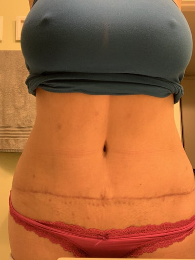 Amazing Tummy Tuck With Internal Corset Muscle Repair Done By The