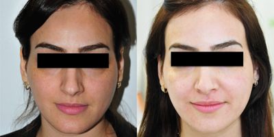 35-44 year old woman treated with Mesotherapy - mesotherapy whitening