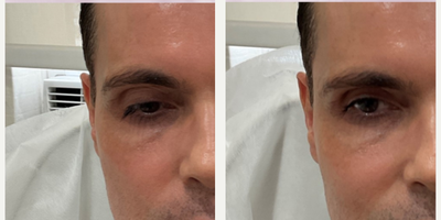 45-54 year old man treated with Renuva - 45-54 year old man treated with Renuva to Temples