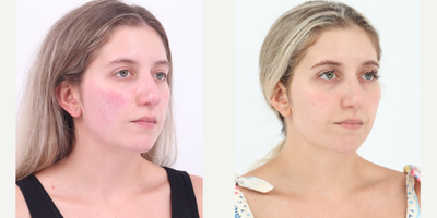 25-34 year old woman treated with BroadBand Light (BBL) - Before and after 3 sessions of BBL to treat rosacea