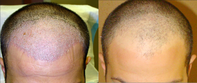 ARTAS robotic FUE hair transplantation - ARTAS robotic hair transplantation - FUE hair transplant that does not create linear scars