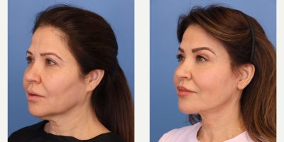 Woman treated with Facelift - Woman treated with Facelift