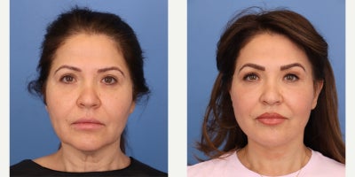 Woman treated with Facelift - Woman treated with Facelift