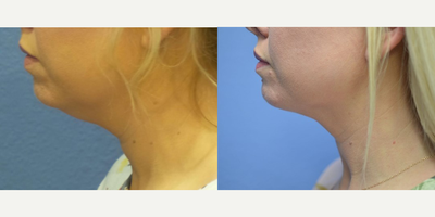 Woman treated with FaceTite - Woman treated with FaceTite