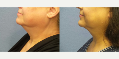 Woman treated with FaceTite - Woman treated with FaceTite