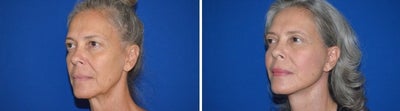 55-64 year old woman treated with Facelift - Facelift