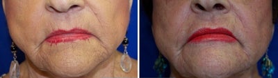 55-64 year old woman treated with Laser Resurfacing - SmartSkin Laser resurfacing to dynamic wrinkles at mouth.