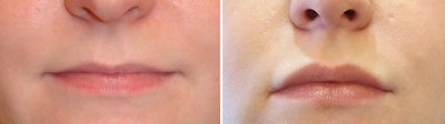 35-44 year old woman treated with Lip Implants - Lip Implant Enhancement