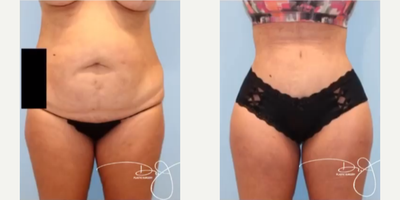 Woman treated with Butt Lift - Woman treated with Natural Butt Lift as well as Tummy Tuck
