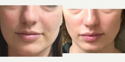 18-24 year old woman treated with Voluma - Patient was treated with Voluma to soften Nasolabial folds
