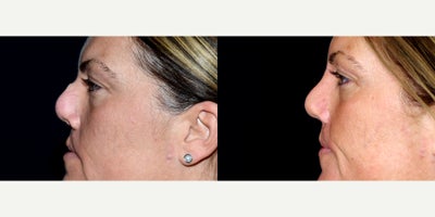 43 year old woman treated with Cleft Lip And Cleft Lip Revision. - 43 year old woman treated with Cleft Lip And Cleft Lip Revision. Photos depict before and 9 months after surgery.