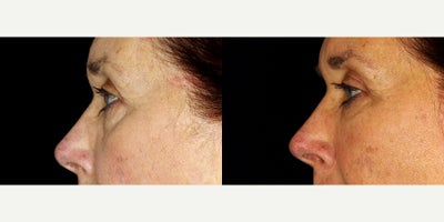 66 year old woman treated with Restylane Refyne - 66 year old woman treated with Restylane Refyne to under eyes. Photos depict before and 2 months after 1 syringe.