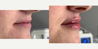 25-34 year old woman treated with Restylane Refyne - Lip fillers with Radhika, the Nurse Practitioner at Wise Med Spa