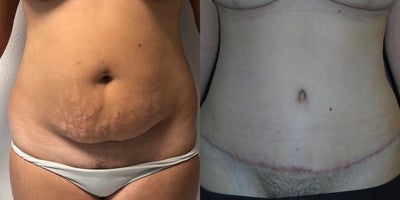 35-44 year old woman treated with Mommy Makeover - This 39 year old mother complained of drooping breasts, but was satisfied with her volume and did not want breast implants. A breast lift (mastopexy) achieved her goals. At the same surgery, a tummy tuck (abdominoplasty) tightened her tummy and improved her shape. The thin scars will fade and become inconspicuous with time.