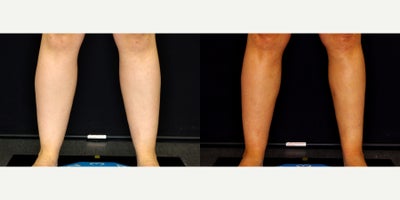 34 year old woman treated with Smart Lipo - 34 year old woman treated with Smart Lipo. Photos depict before and 4 months after surgery.