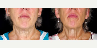 60 year old woman treated with Ultherapy to lower face and neck. - 60 year old woman treated with Ultherapy to lower face and neck. Photos depict before and 3 months after treatment.