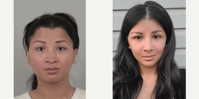 25-34 year old woman treated with AccuLift, Cheekbone Reduction, Facial Fat Transfer, Ptosis Surgery, Rhinoplasty, V Line Surger - .
