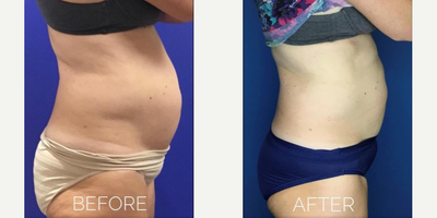 35-44 year old woman treated with UltraShape and VelaShape - 35-44 year old woman treated with UltraShape and VelaShape
