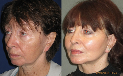 55-64 year old woman treated with Fat Transfer, Facelift, and Chin Augmentation - This wonderful patient presented to our Center with the complaints of not looking lively and healthy.  After a through evaluation, we mutually decided to perform a lower facelift/necklift with a chin augmentation and fat transfer to her cheeks and midface.  All three procedures were safely performed on the same day in our Center under local anesthesia and oral sedation.  The patient tolerated the procedure quite well and was without any significant swelling or bruising after just one week.  Her results are quite significant in that her midface is much more full and balanced from the fat transfer, and her lower face is more defined due to the chin augmentation and tightening of the facial muscles and skin.