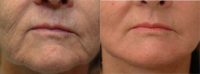 65-74 year old woman treated with Laser Resurfacing - Peri-Oral laser
