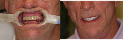 65 year old male treated with All-on-4 Dental Implant Procedure - 65 year old male treated with All-on-4 Dental Implant Procedure