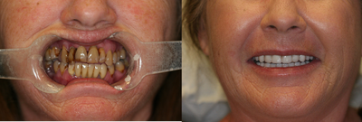 68 year old Female treated with All-on-4 Dental Implant Procedure - 68 year old Female treated with All-on-4 Dental Implant Procedure