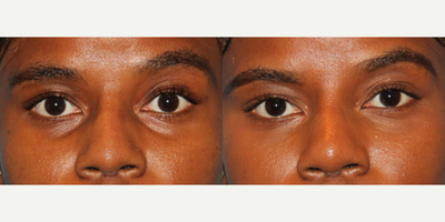18-24 year old woman treated with Restylane Silk - This patient was unhappy with the hollowing under her eyes. We injected less than a full syringe of Restulane silk in the tear troughs and the patient is very satisfied with her results. Not only will she get about six months to one year out of the treatment,