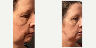 55-64 year old woman treated with Evolve - This client has been unhappy with her jowls for sometime. When doing the evoke treatment best results are seen 6 weeks after you do your last treatment. Treatments are 1 time weekly for 6 weeks. Although these before and afters are prior to her last treatment there has already been noticeable improvement.
