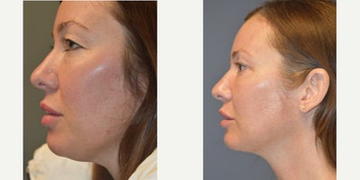 45-54 year old woman treated with Chin Liposuction, CO2 Laser, Double Eyelid Surgery, Eyelid Surgery, Fractional Laser, Laser Re - This woman presented with drooping of the upper eyelids, heavy under eye bags, and fullness in her chin that just bothered her! Dr Woodman listened to her concerns and provided a conservative approach that gave fantastic results. Removing excess skin from the upper eyelids, some of the excess fat that filled out the lower lid (some of us with hollow under eyes WISH we had that fat under there!), and a bit of lipo below the chin were the only incision points, with the only scar left visible being a tiny one under the chin. The laser Blepharoplasty (Upper Eyelid surgery technique we use) scar is hidden within the natural crease, the lower incision is in the lash line- you will never see it!To finish, Dr Woodman gave her an overall CO2 resurfacing refresh, and the results speak for themselves.