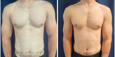 Woman treated with Gynecomastia Surgery - Woman treated with Gynecomastia Surgery